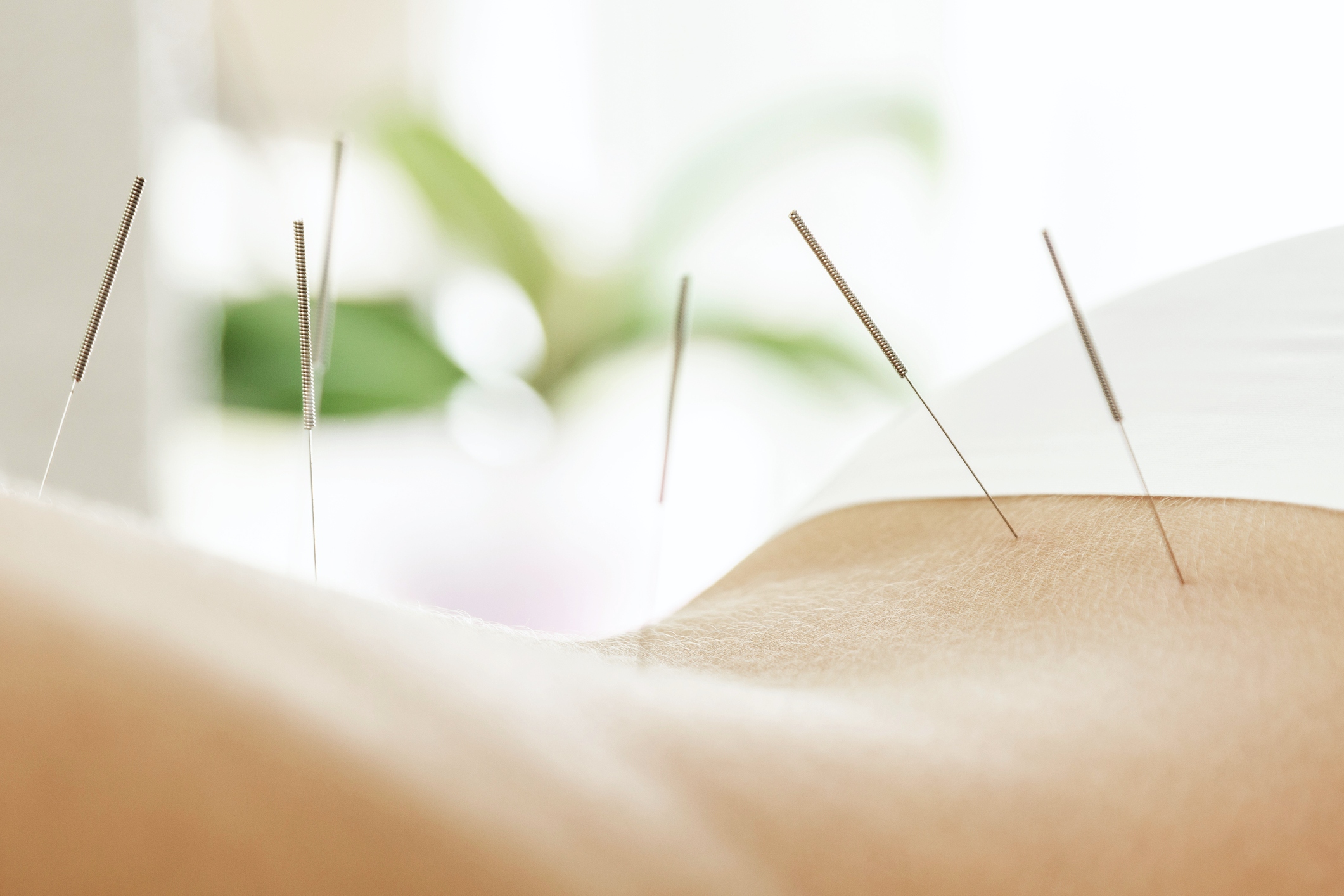 acupuncture for natural pain relief